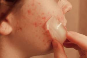 التخلص من البثور