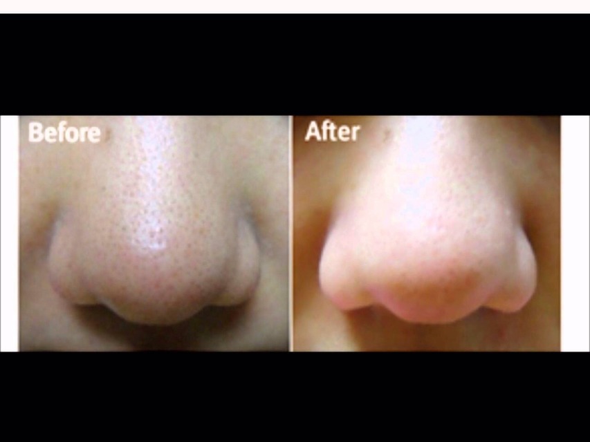 Mixtures to remove blackheads from the nose