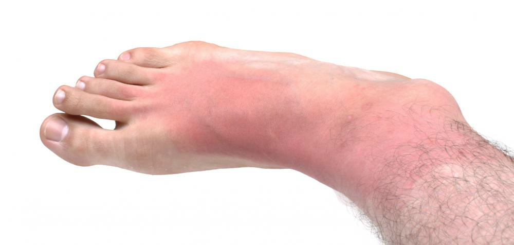 foot with red irritated skin