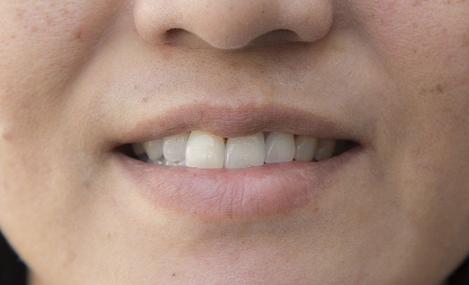 How to use banana peel to whiten teeth