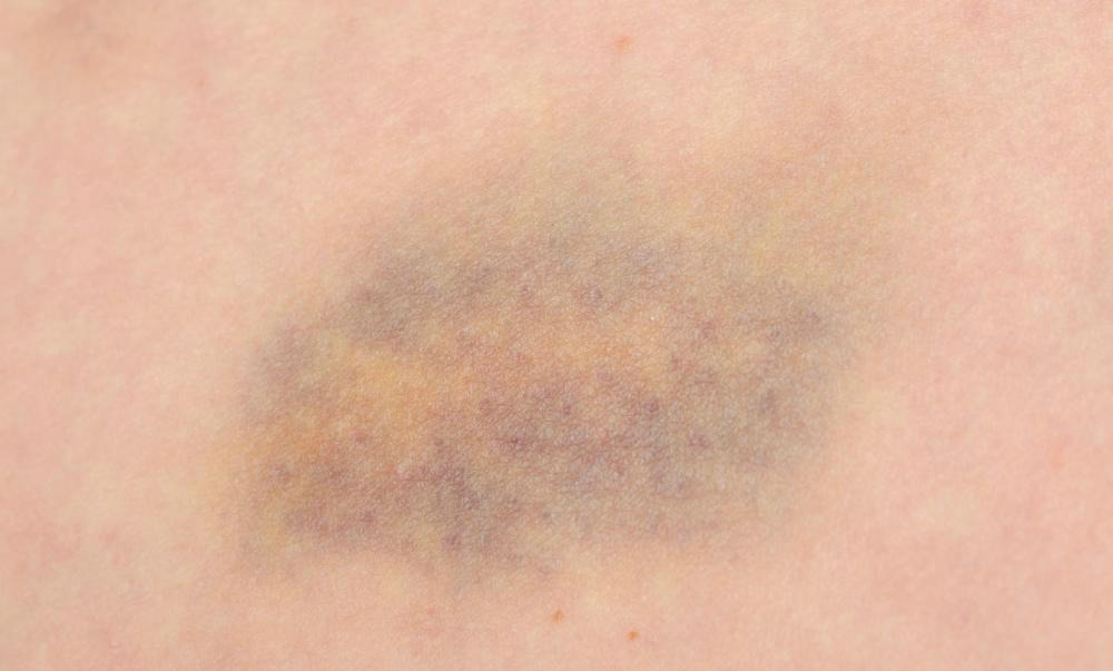 bruise close up
