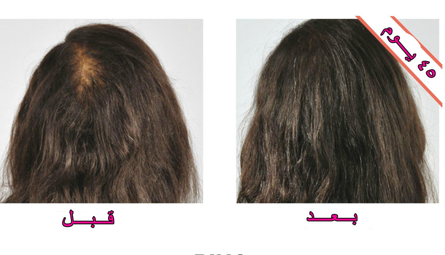 وصفات لزيادة نمو الشعر