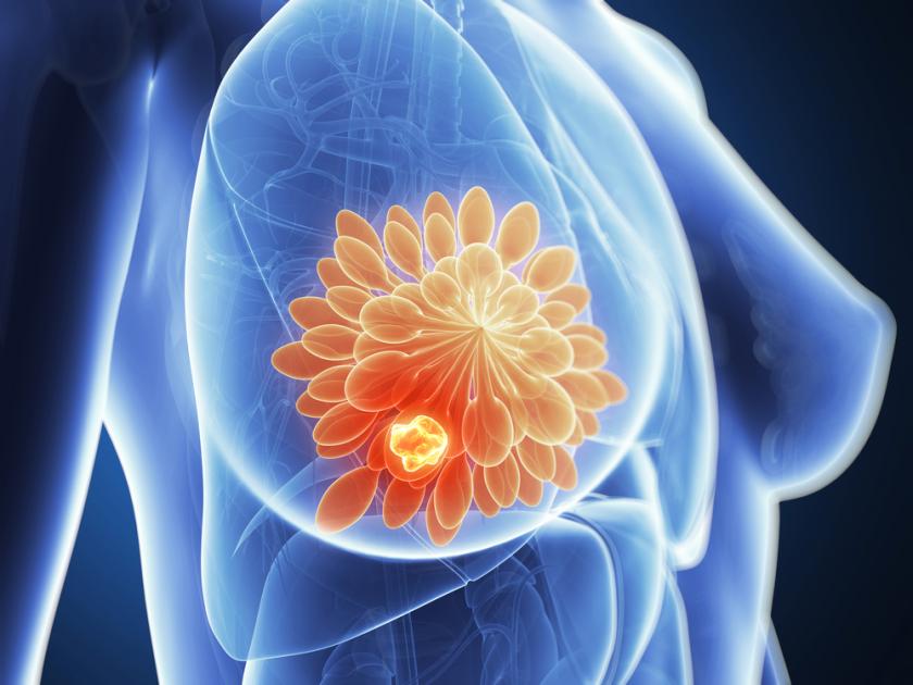 الحماية من سرطان الثدي ثقف نفسك