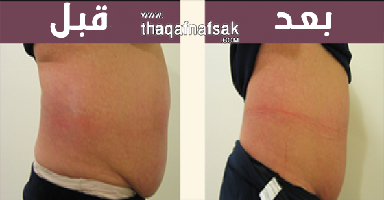 الميزوثيرابي لخسارة الوزن الزائد، ثقف نفسك