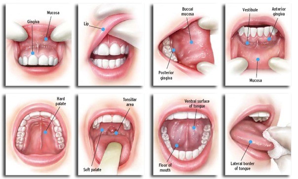 ٨ علامات لاكتشاف سرطان الفم مبكرا ثقف نفسك