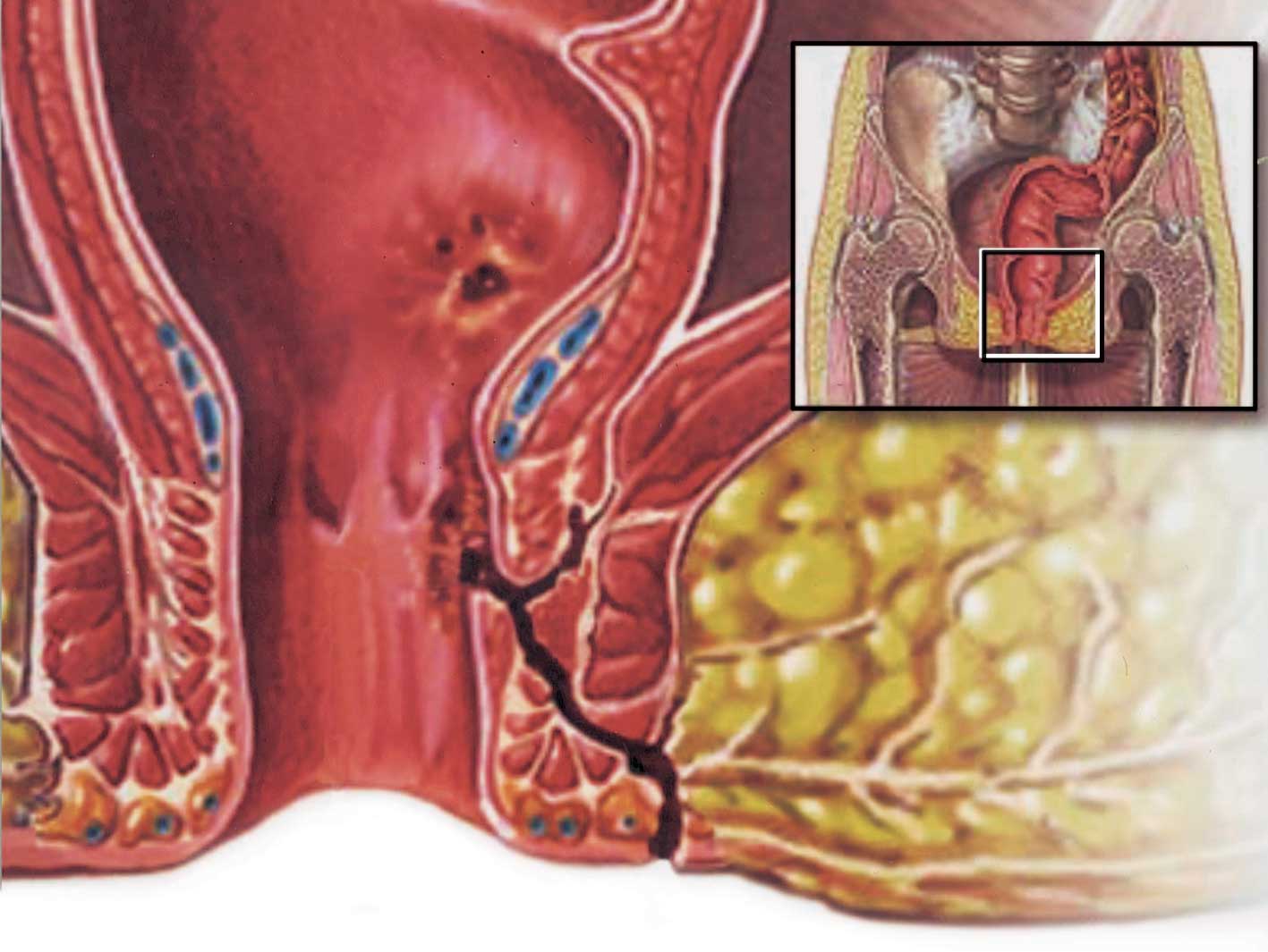 الناسور الشرجي: أسبابه وطرق علاجه ومضاعفاته.  ثقف نفسك
