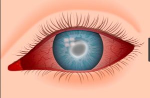أنواع التهاب العين الفيروسي - ثقف نفسك