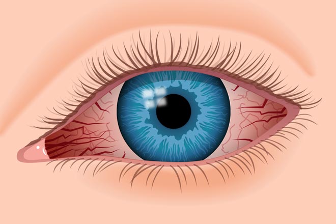 تقليل وعلاج إجهاد العين