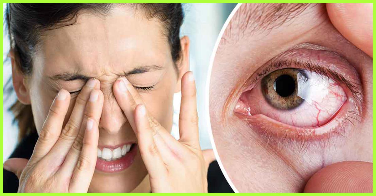 جفاف العين أعراض تؤكد إصابتك به وأسبابه لتتجبنها فوراً