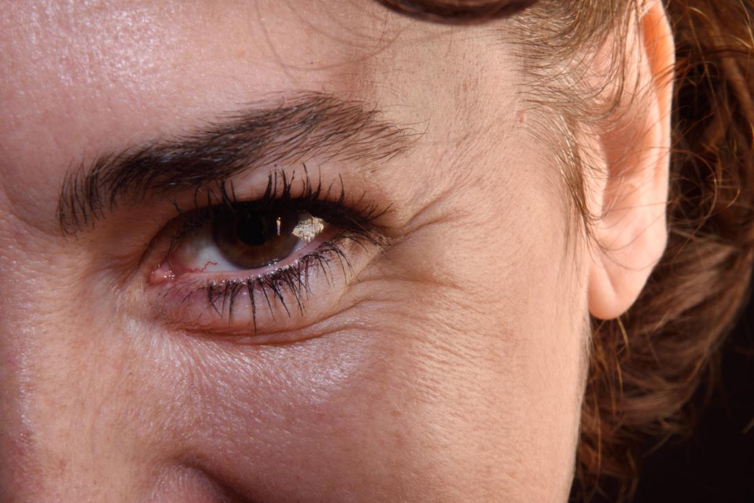 علاج جفاف الجلد حول منطقة العين ثقف نفسك