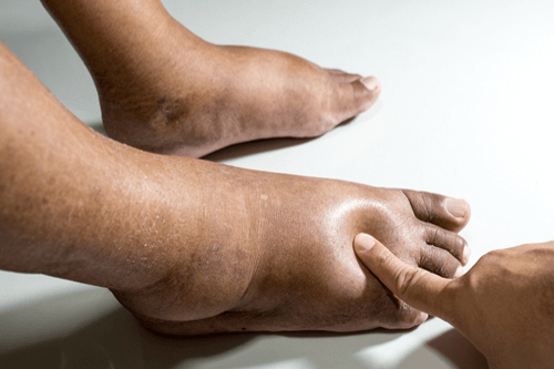 علاج انتفاخ القدمين و الساقين