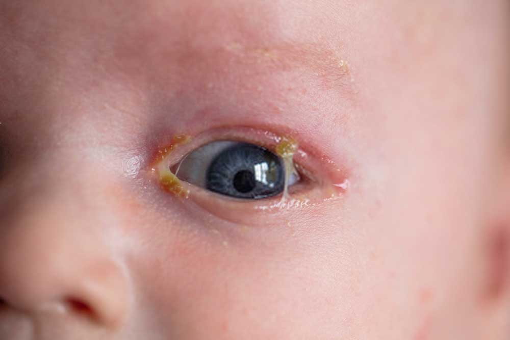 حساسية القمح للاطفال الرضع متلازمة الطفل المرتج