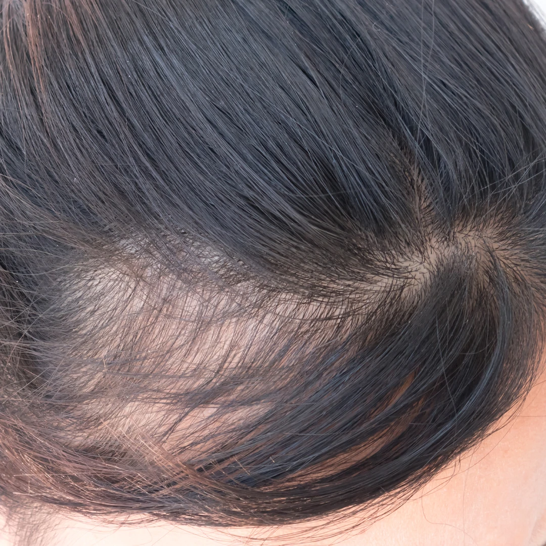 Выпадают волосы у женщины сильно на голове. Андрогенная алопеция алопеция. Очаговая (гнездная) алопеция. Андрогенетическая диффузная алопеция.