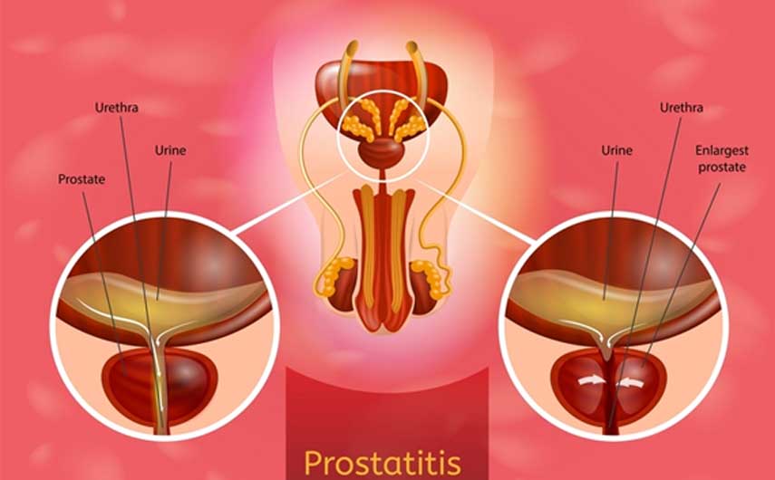 أعراض التهاب البروستاتا