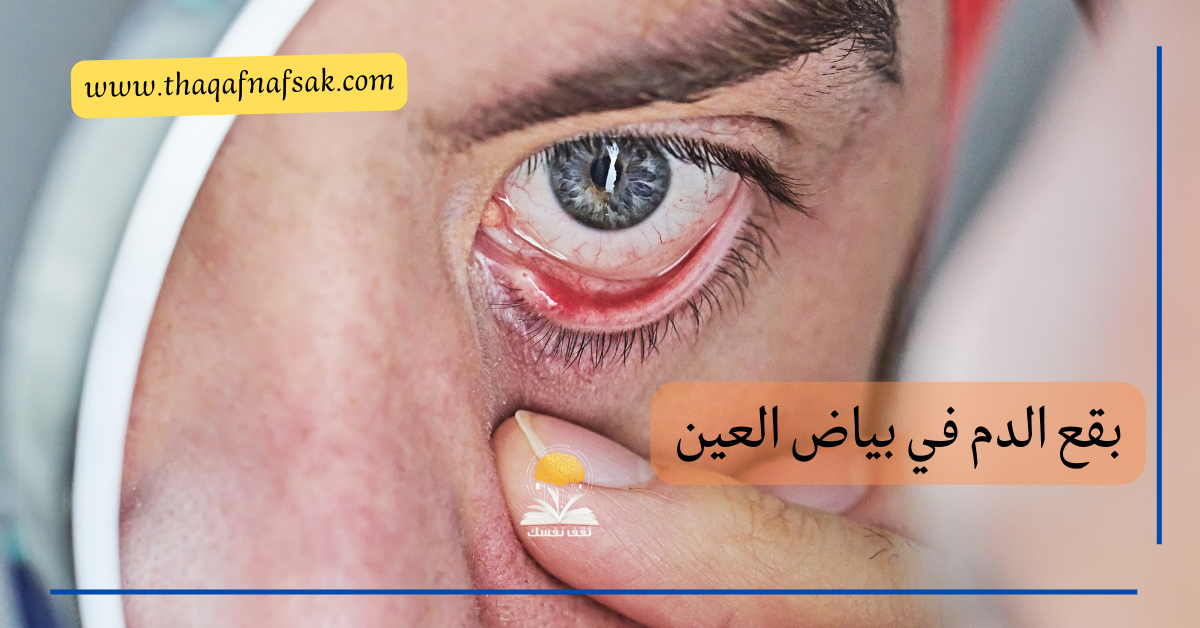 بقع الدم في بياض العين