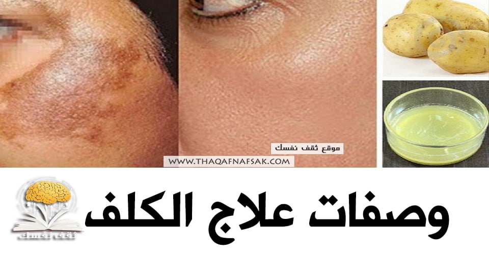 وصفات علاج الكلف&nbsp;&nbsp;
