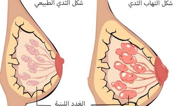اسباب التهاب أنسجة الثدي