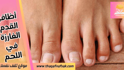 أظافر القدم الغارزة في اللحم